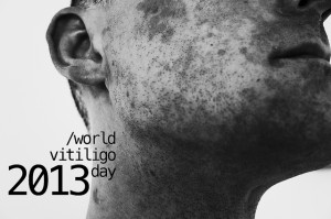 A vitiligo kezelése nem lehetetlen