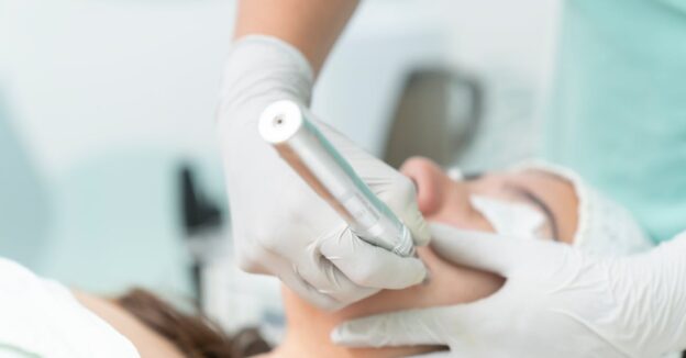 Microneedling Debrecen az Apollon Beauty szépségszalonban